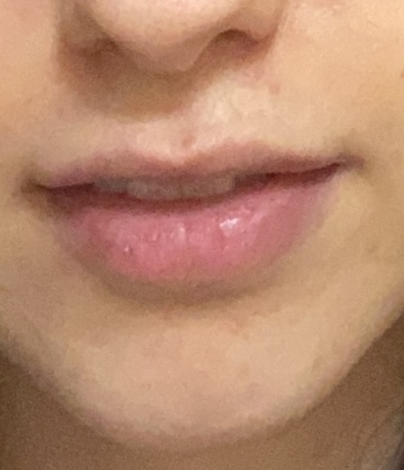 Do you think some lip fillers on my upper lips would make them much nicer?