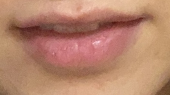 Do you think some lip fillers on my upper lips would make them much nicer?