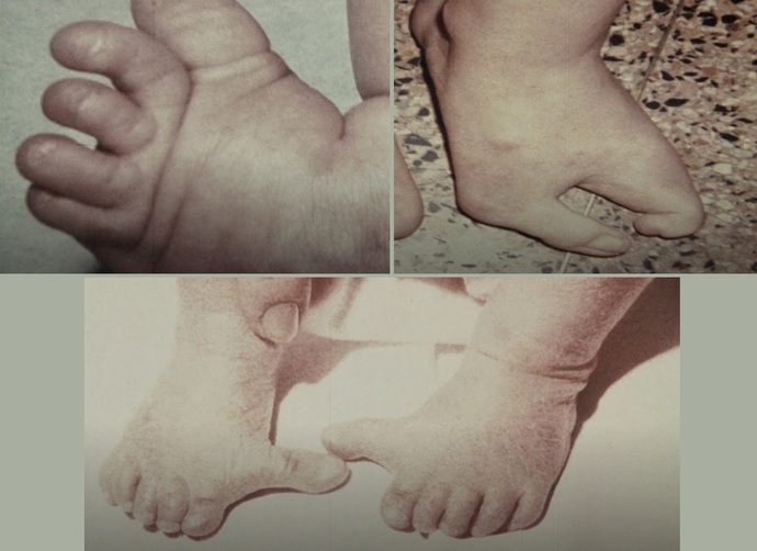 [+18 - Graphic] Do you know what inbreeding does to the fetus?