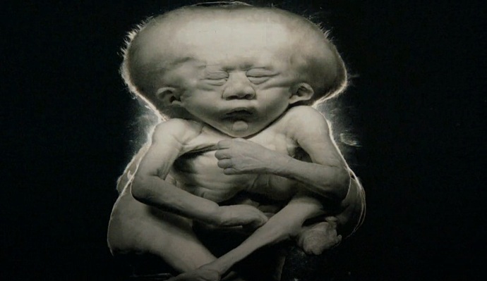 [+18 - Graphic] Do you know what inbreeding does to the fetus?