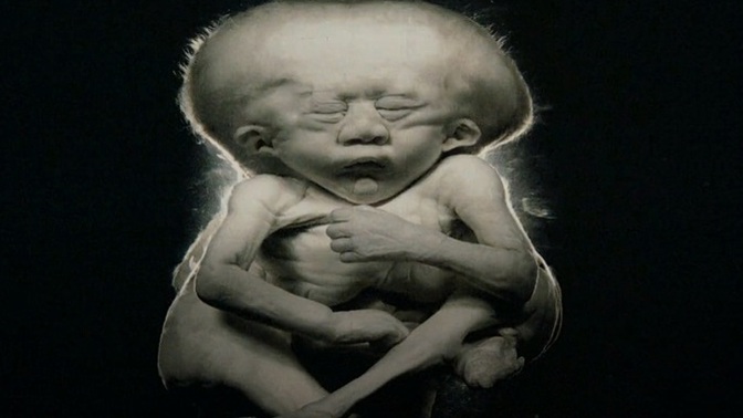 [+18 - Graphic] Do you know what inbreeding does to the fetus?
