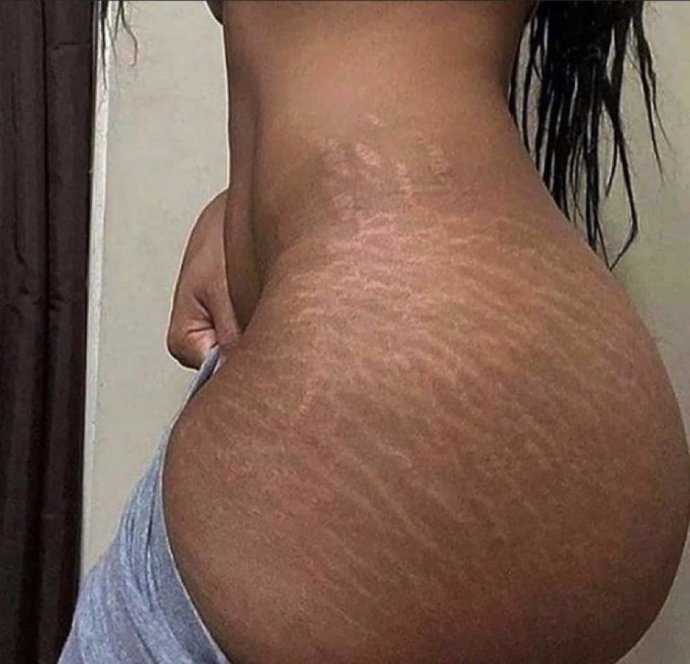 What causes stretch marks and is there a fix?