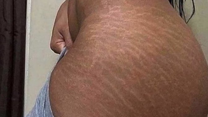 What causes stretch marks and is there a fix?