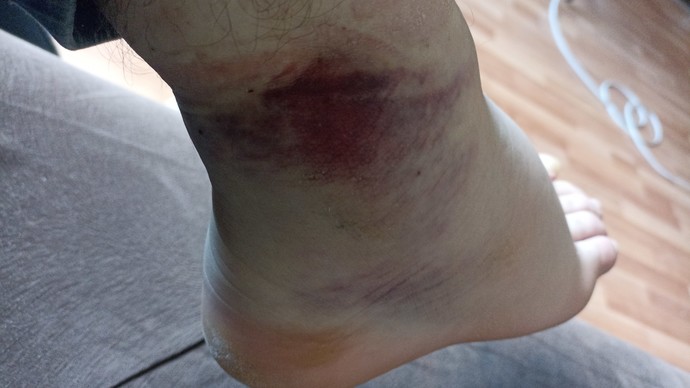 Does my foot look bad?