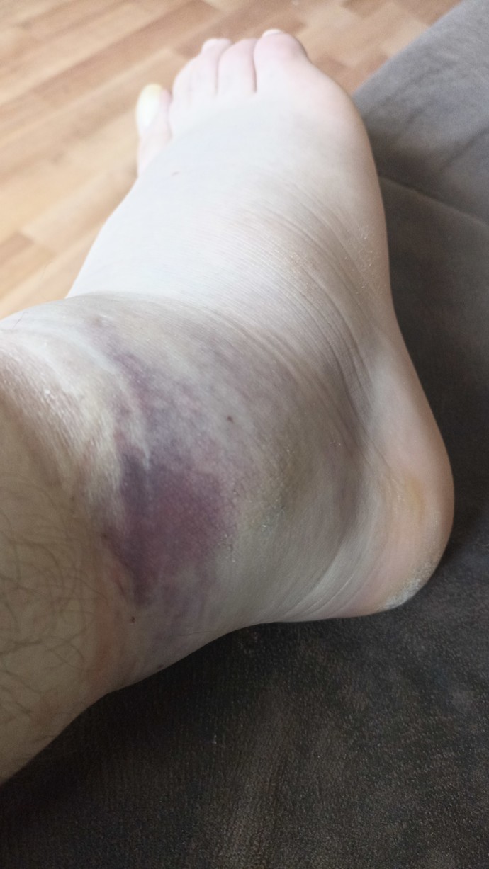 Does my foot look bad?