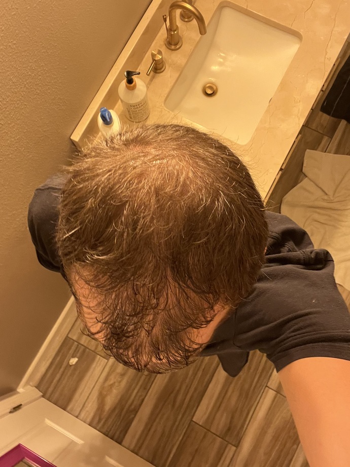 Guys, what methods, if any, have you used to regrow hair from thinning hair I male pattern baldness?