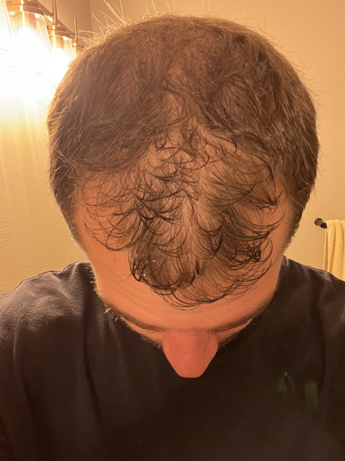 Guys, what methods, if any, have you used to regrow hair from thinning hair I male pattern baldness?