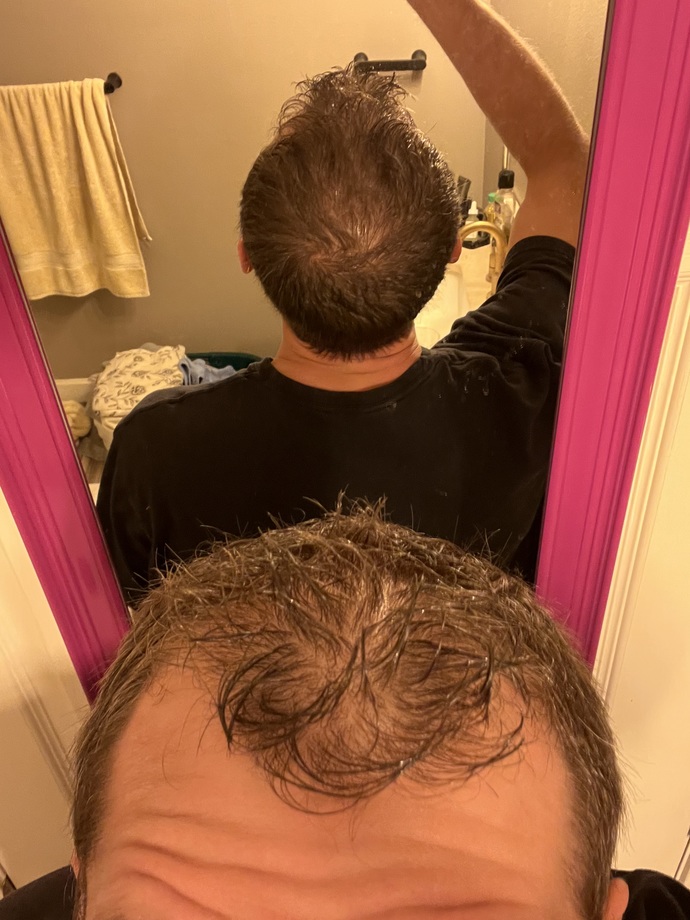 Guys, what methods, if any, have you used to regrow hair from thinning hair I male pattern baldness?