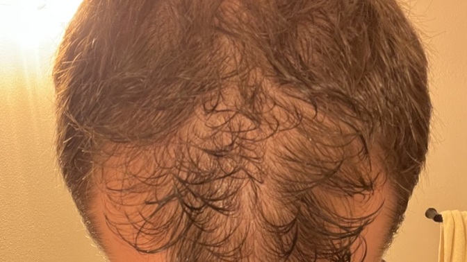 Guys, what methods, if any, have you used to regrow hair from thinning hair I male pattern baldness?
