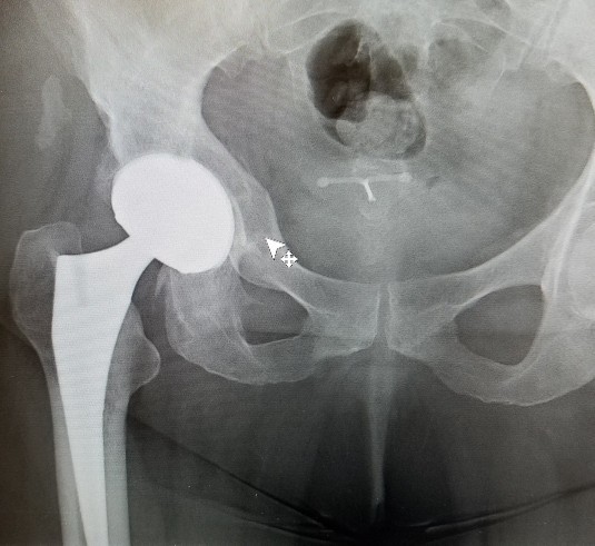Does your body have any replacement parts? Was it worth it?