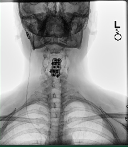 Does your body have any replacement parts? Was it worth it?