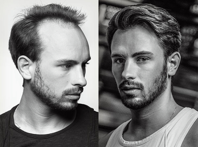 What's a good hairstyle for a guy with male pattern baldness?