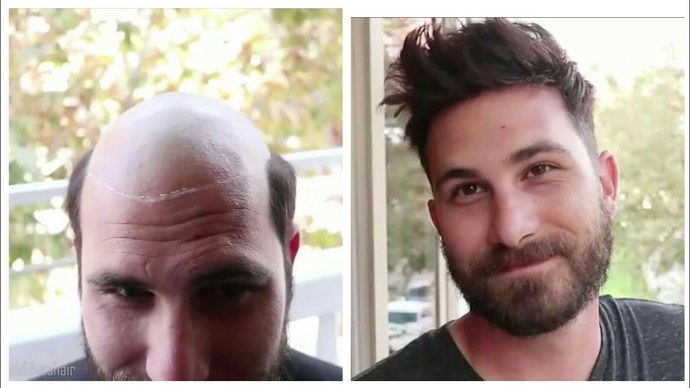 What's a good hairstyle for a guy with male pattern baldness?