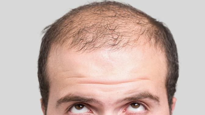 What's a good hairstyle for a guy with male pattern baldness?
