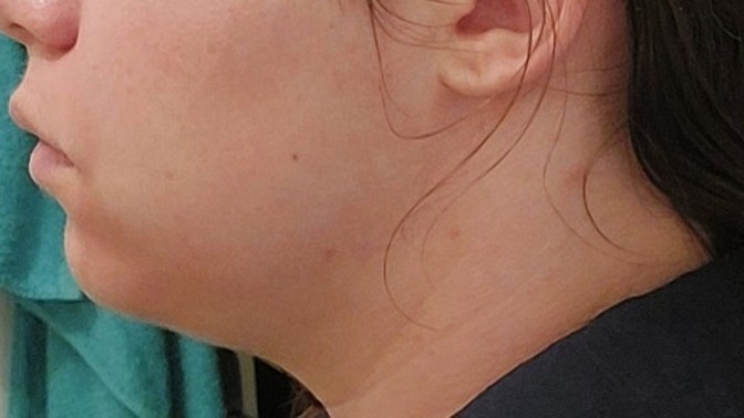 Weak chin or just fat?
