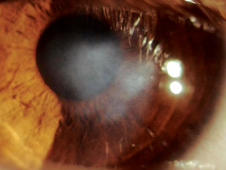 Cornea haze