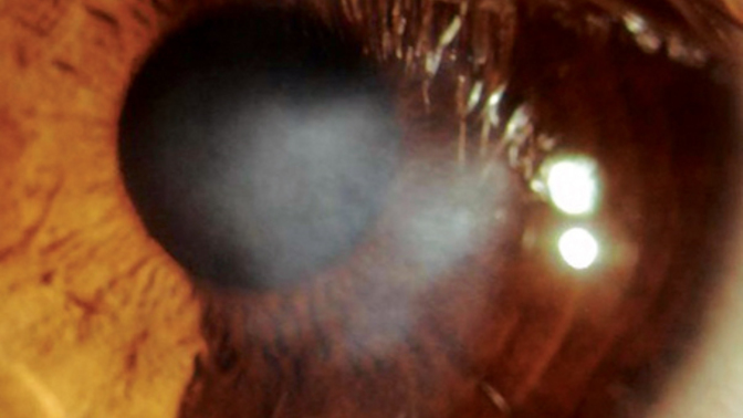 Why did I go blind?