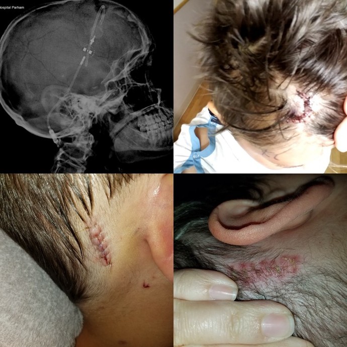 Csf or not should I worry?