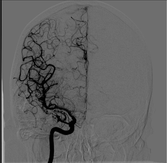 Csf or not should I worry?