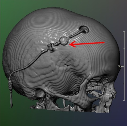 Csf or not should I worry?