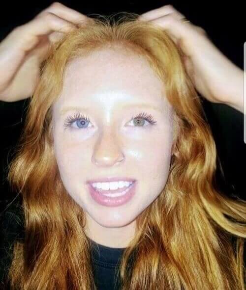 Born with one blue and one green eye