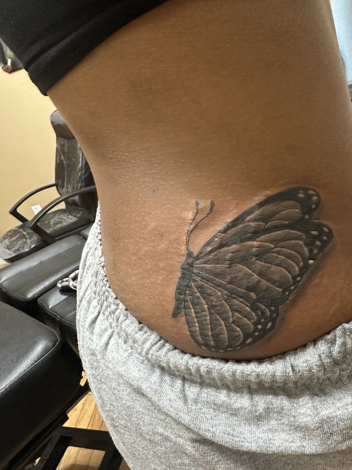 I just got it redone 2 minutes ago!!! It’s a little swollen but a big upgrade