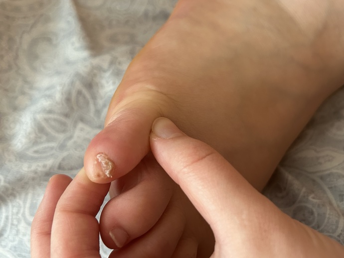 Why and what causes my Toe nail to be like this?