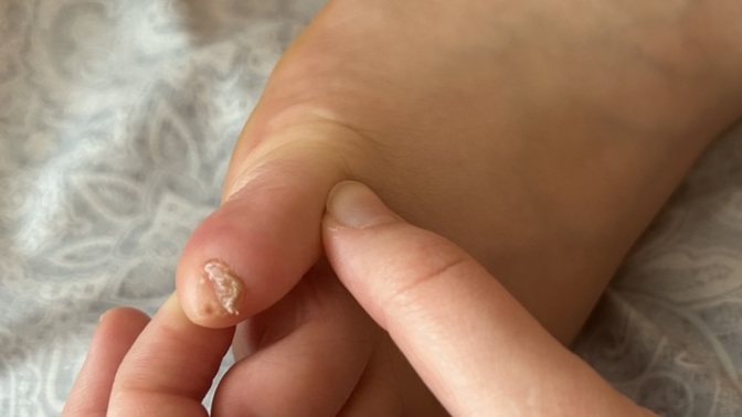 Why and what causes my Toe nail to be like this?