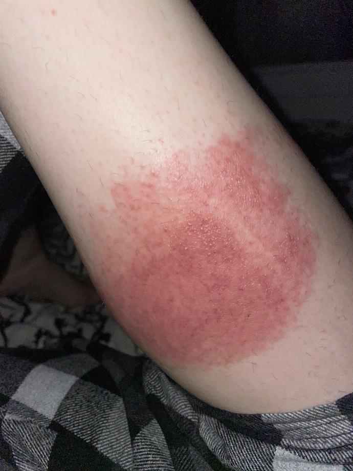 What type of rash does this look like?