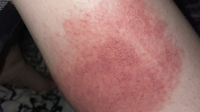 What type of rash does this look like?