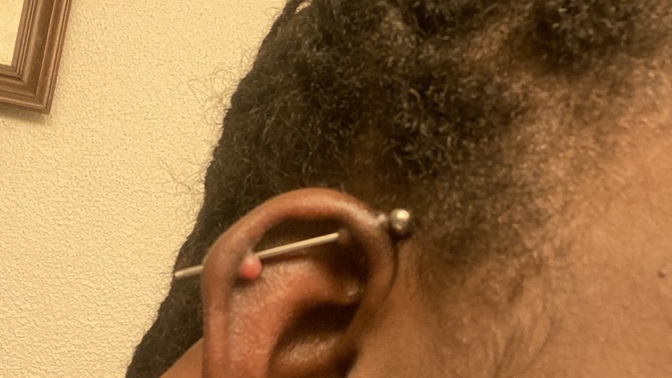 Are these piercing bumps or keloids? And what do I need to do to get them removed?