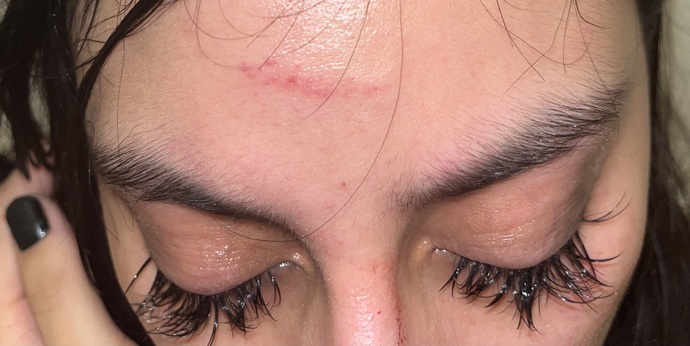 My boyfriend just hit me should I go get stitches or what should I do (pic)?