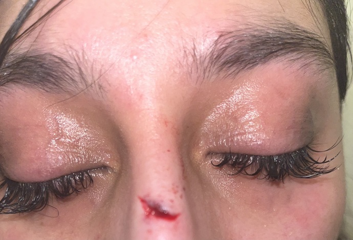 My boyfriend just hit me should I go get stitches or what should I do (pic)?