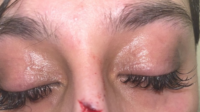 My boyfriend just hit me should I go get stitches or what should I do (pic)?
