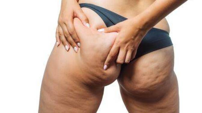Do guys hate cellulite?