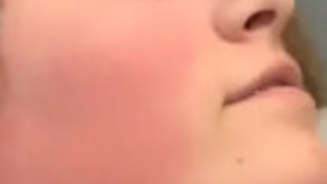 Girls, Insecure about my red cheeks. Are they attractive to girls?