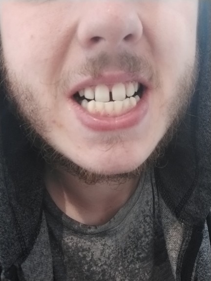 Ladies, if you went on a date with a guy from a dating and had teeth like these would you leave or give him a chance?