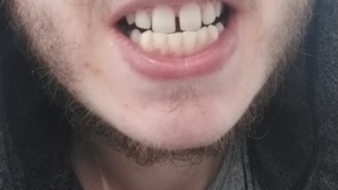Ladies, if you went on a date with a guy from a dating and had teeth like these would you leave or give him a chance?