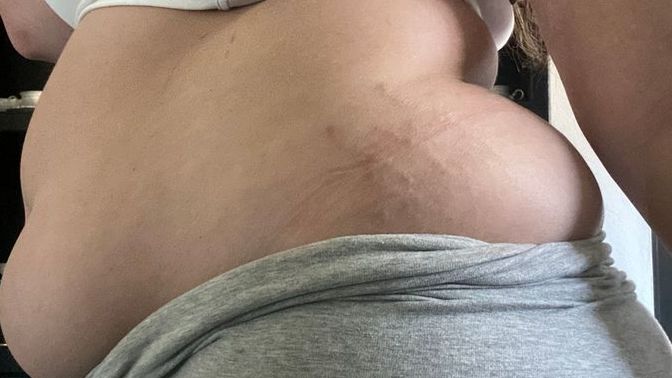 What is this on my hips?