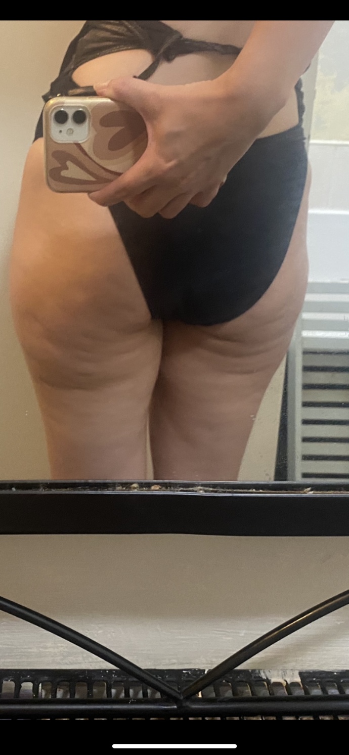 Is this a bad level of cellulite and why does the above angle reduce and the below brings it out?