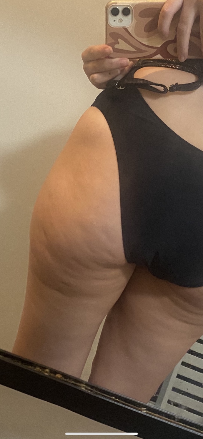 Is this a bad level of cellulite and why does the above angle reduce and the below brings it out?