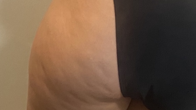 Is this a bad level of cellulite and why does the above angle reduce and the below brings it out?