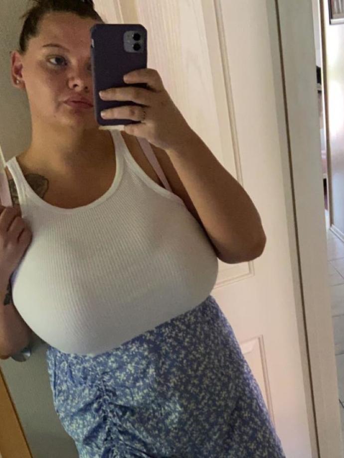 Should government health systems pay for breast reduction?