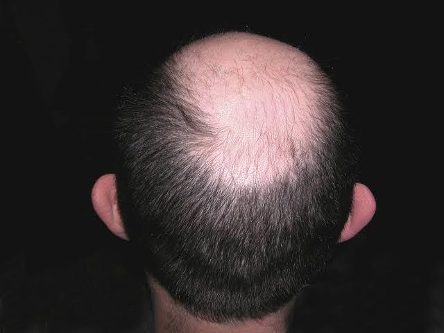 How do you feel about baldness in men?