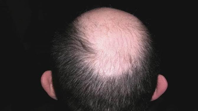 How do you feel about baldness in men?