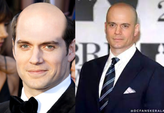 Should balding men shave their heads or keep receding hairlines?