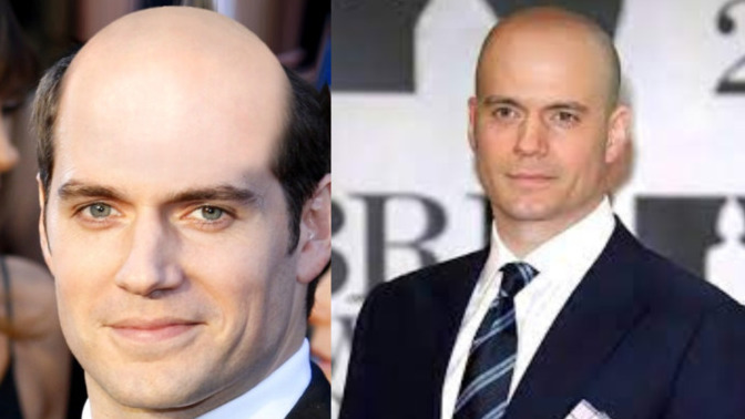 Should balding men shave their heads or keep receding hairlines?