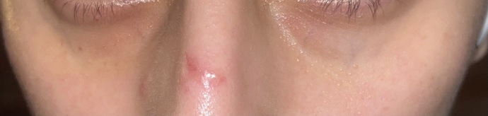 Can I get laser on this cut on my nose (pic) ?