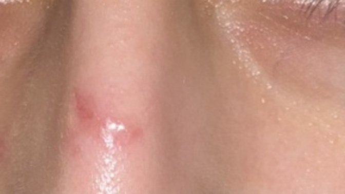 Can I get laser on this cut on my nose (pic) ?