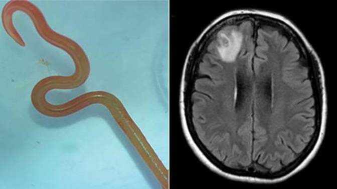 What would you do it there was a worm in your brain?